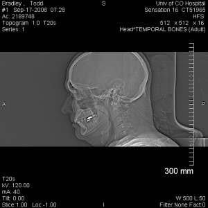 Todd in profile as seen by the CT scan