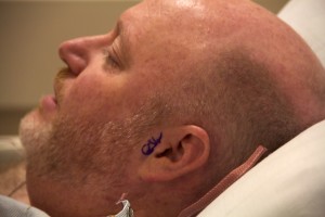 As one of many precautions, the surgeon signed my ear, to make sure everyone involved operated only on the left ear and not accidentally on the right one