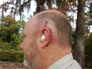 Here's the most gruesome of all the post-surgery photos. It shows the incision wound held together by surgical staples. This was during a walk that Beth and I took in a nearby park.
